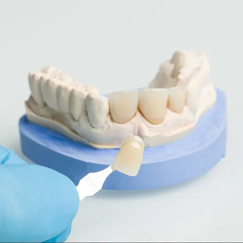 Corona dental